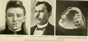Black-and-white medical diagram of two Parry Romberg Syndrome patients circa 1920, attributed to Dr. Byrom Bramwell